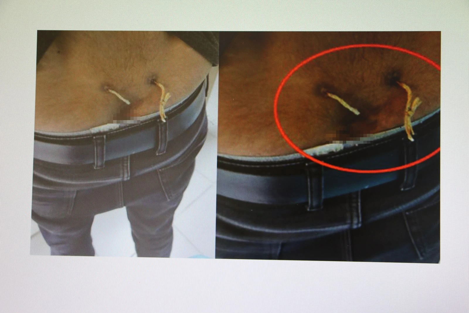 Ağrıları geçsin diye belinden çamaşır ipi geçirdiler